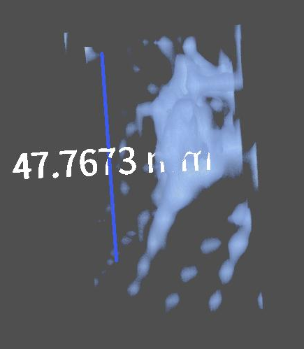 Volume rendering of lesion